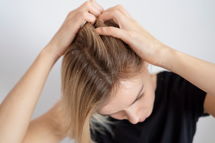 Close-up of dandruff flakes in hair