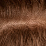 female pattern hair loss
