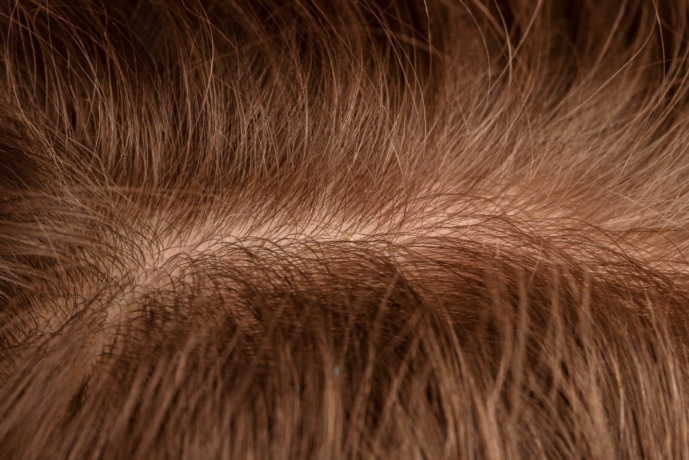 female pattern hair loss